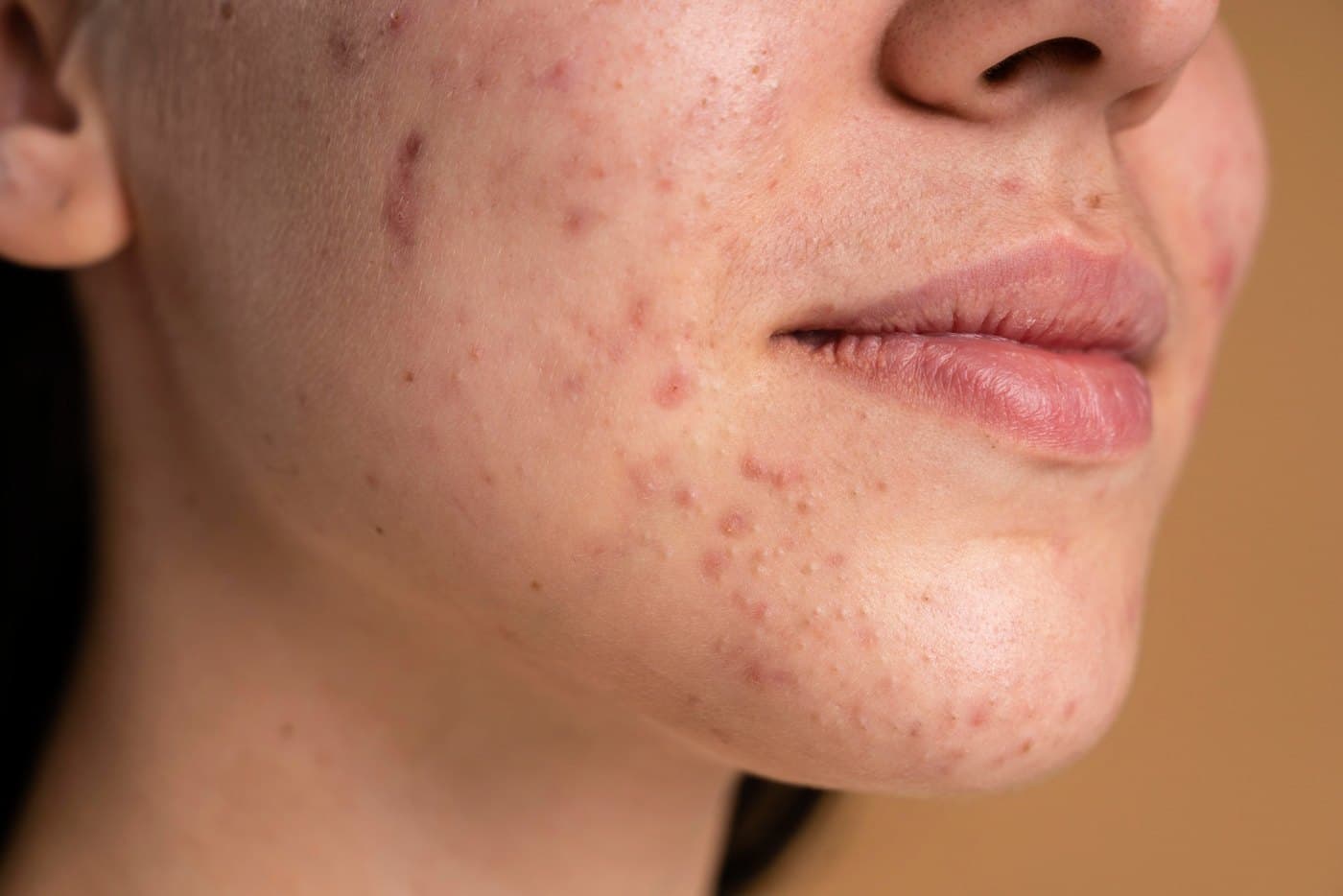 Close-up of acne and scarring along the jaw