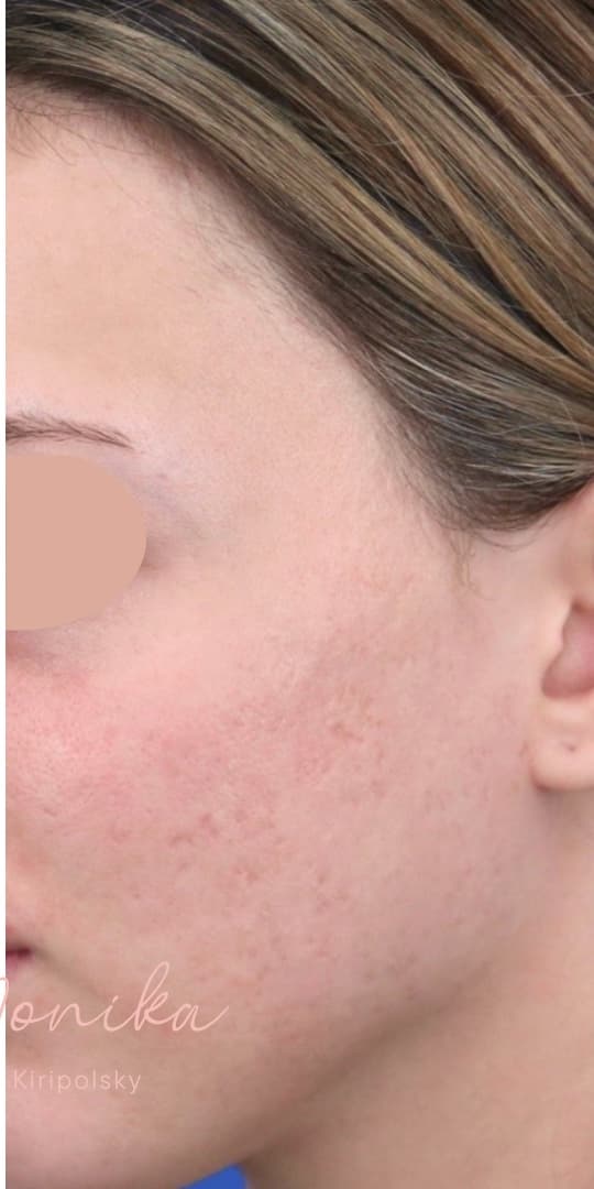After: Acne Scarring Before & After Patient #1680