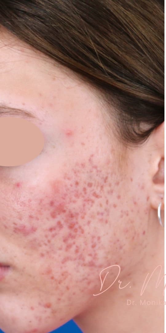 Before: Acne Scarring Before & After Patient #1680