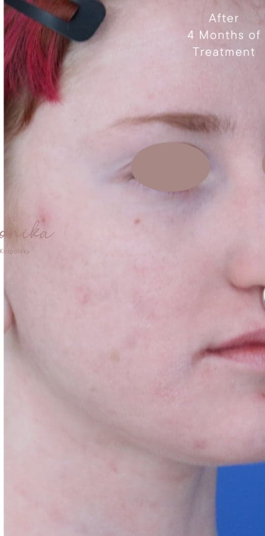 After: Acne Scarring Before & After Patient #1868