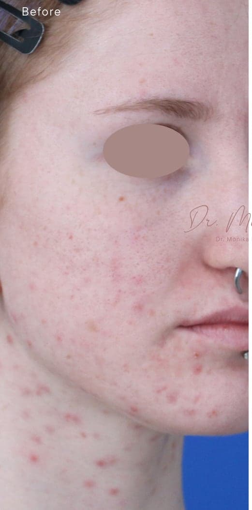 Before: Acne Scarring Before & After Patient #1868