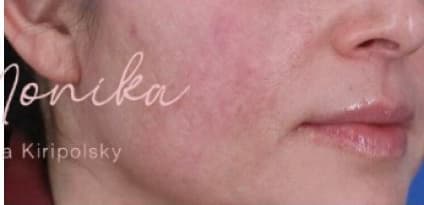 After: Acne Scarring Before & After Patient #619