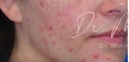 Before: Acne Scarring Before & After Patient #619