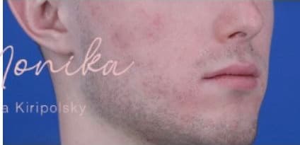 After: Acne Scarring Before & After Patient #620