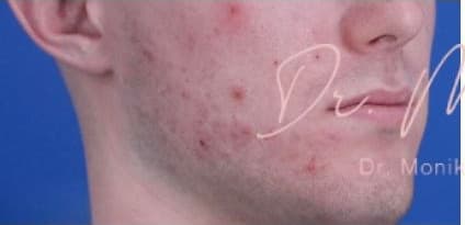 Before: Acne Scarring Before & After Patient #620