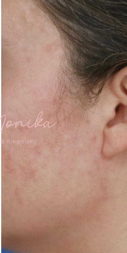 After: Acne Scarring Before & After Patient #621