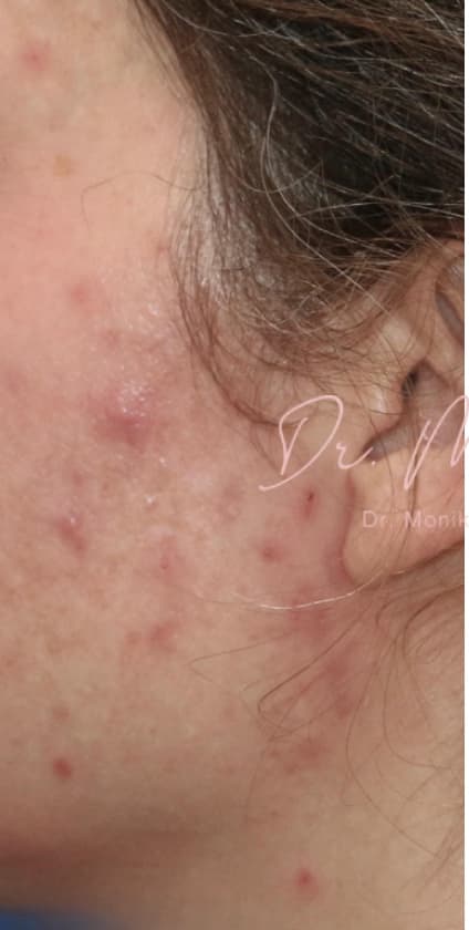 Before: Acne Scarring Before & After Patient #621