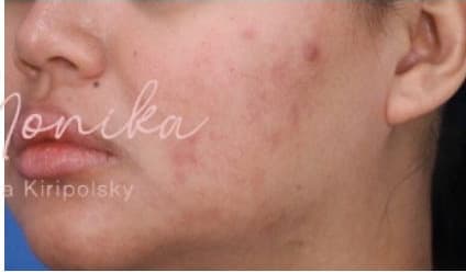 After: Acne Scarring Before & After Patient #623