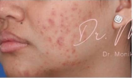 Before: Acne Scarring Before & After Patient #623