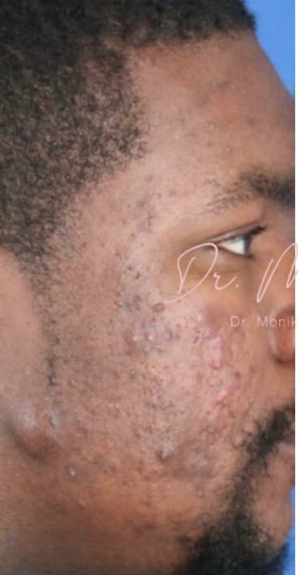 Before: Acne Scarring Before & After Patient #624