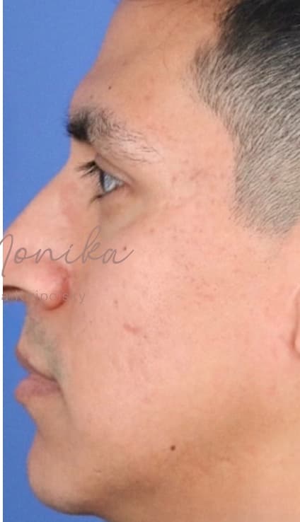 After: Acne Scarring Before & After Patient #637