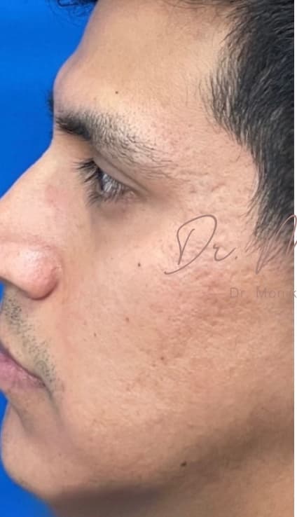Before: Acne Scarring Before & After Patient #637