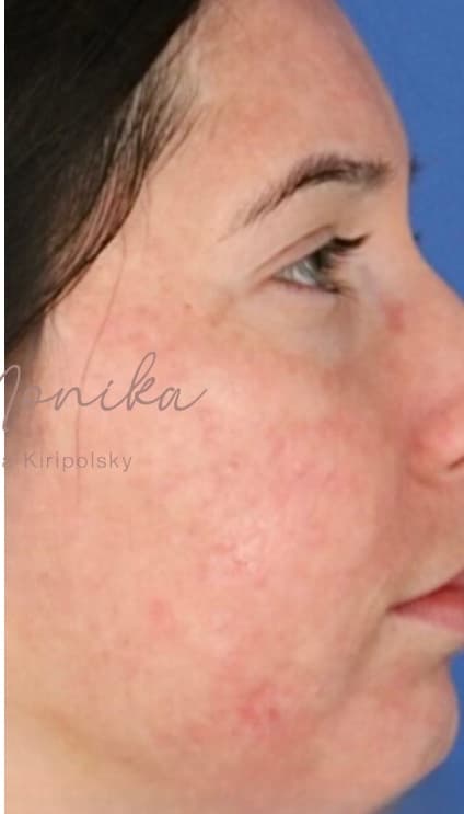 After: Acne Scarring Before & After Patient #638