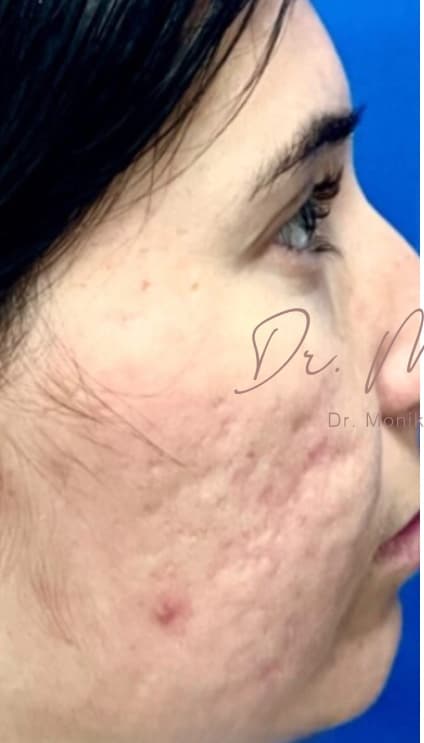 Before: Acne Scarring Before & After Patient #638
