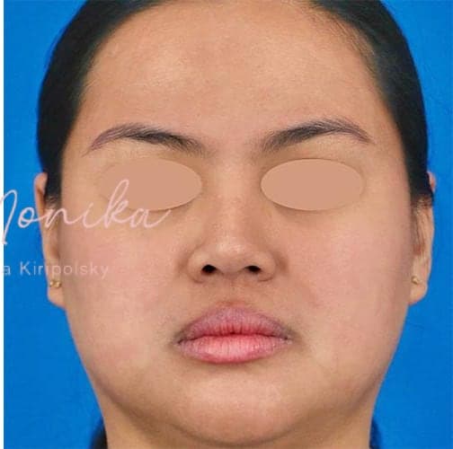 After: Acne Scarring Before & After Patient #775