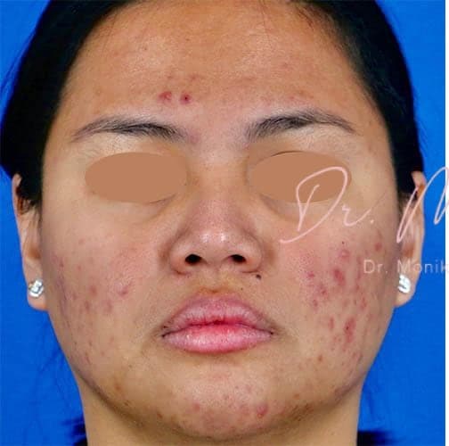 Before: Acne Scarring Before & After Patient #775