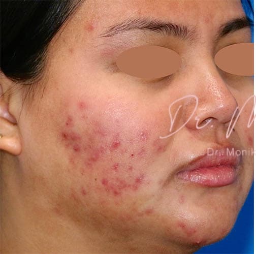 Before: Acne Scarring Before & After Patient #775