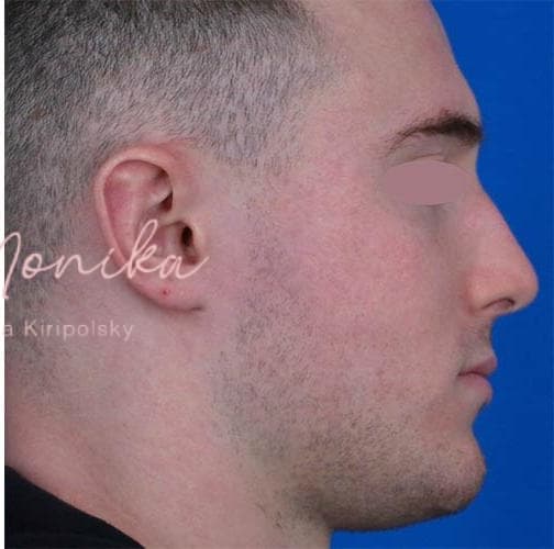 After: Acne Scarring Before & After Patient #776