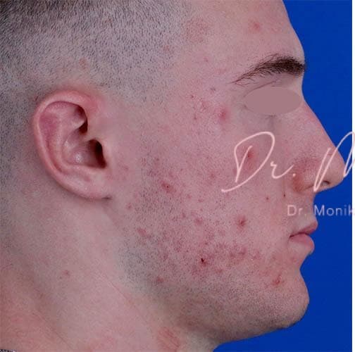 Before: Acne Scarring Before & After Patient #776