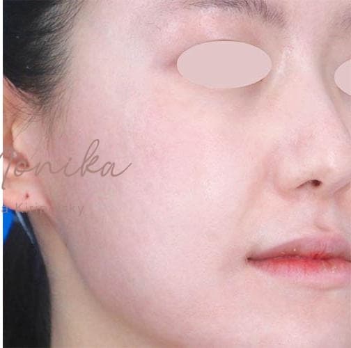 After: Acne Scarring Before & After Patient #777