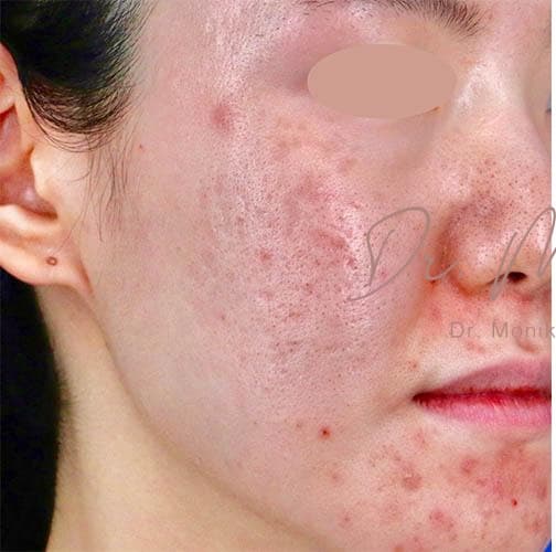 Before: Acne Scarring Before & After Patient #777