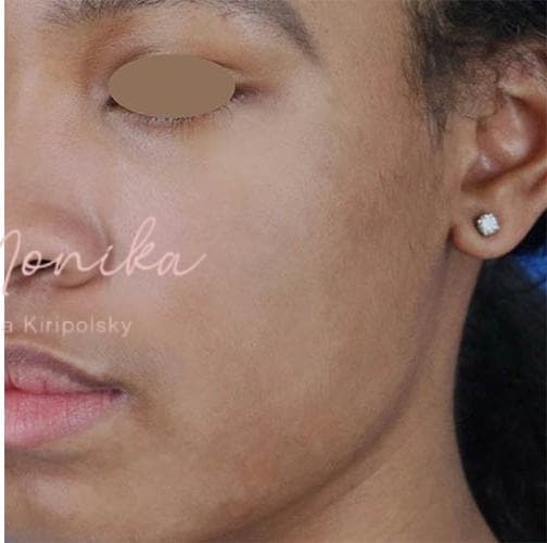 After: Acne Scarring Before & After Patient #778