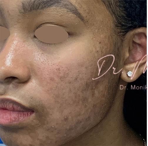 Before: Acne Scarring Before & After Patient #778
