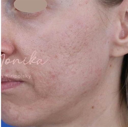 After: Acne Scarring Before & After Patient #779