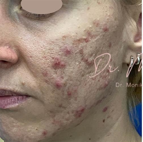 Before: Acne Scarring Before & After Patient #779