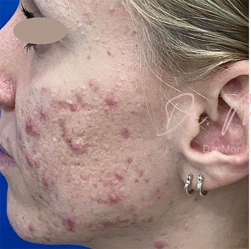 Before: Acne Scarring Before & After Patient #779