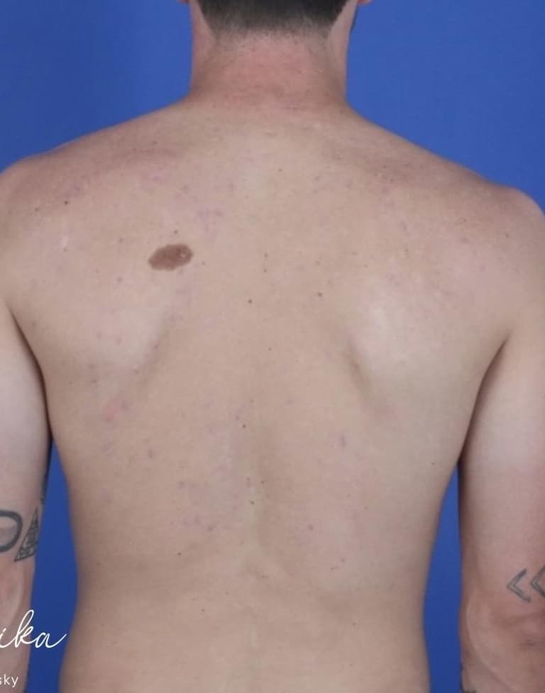 After: Back Acne Before & After Patient #2087