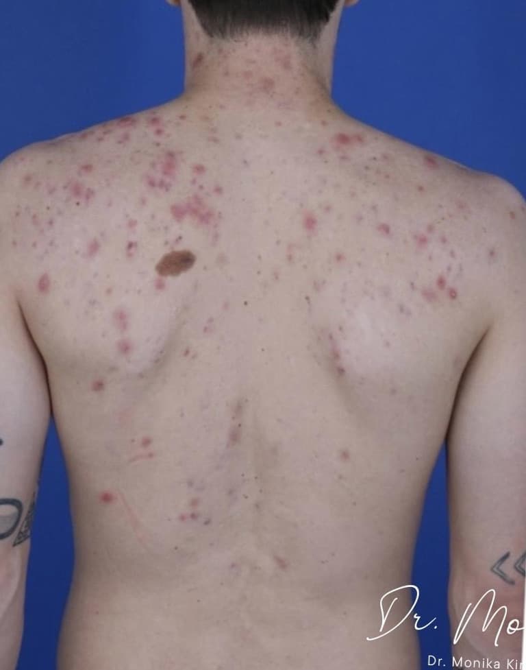 Before: Back Acne Before & After Patient #2087