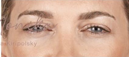 After: Botox Before & After Patient #602