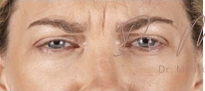 Before: Botox Before & After Patient #602