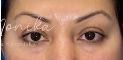 After: Botox Before & After Patient #603