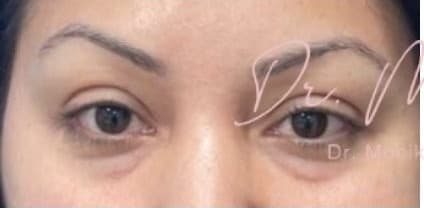 Before: Botox Before & After Patient #603