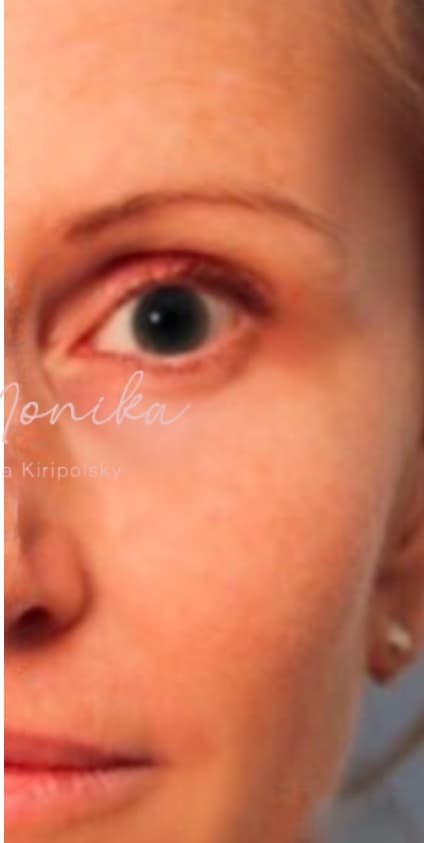 After: Botox Before & After Patient #604