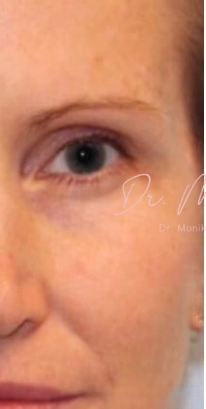 Before: Botox Before & After Patient #604