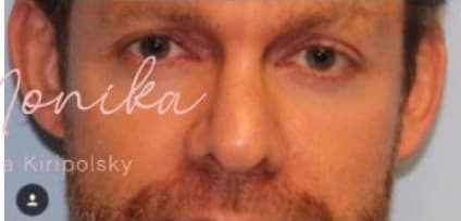 After: Botox Before & After Patient #605