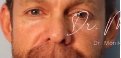 Before: Botox Before & After Patient #605