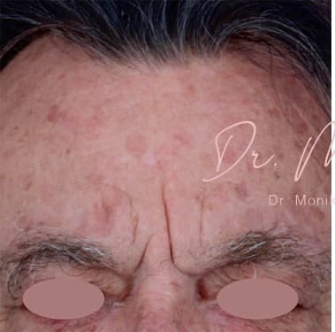 Before: Chemical Peel Before & After Patient #1089