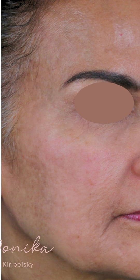After: Chemical Peel Before & After Patient #1665