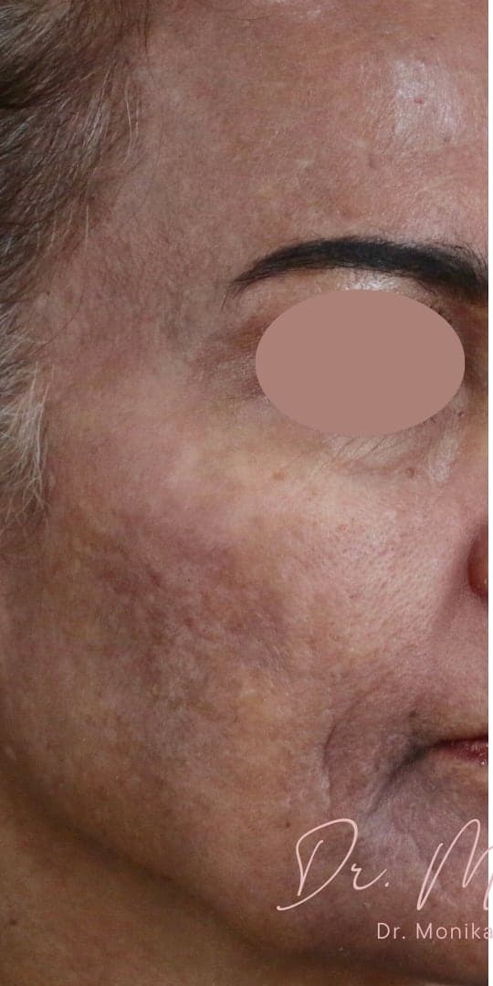 Before: Chemical Peel Before & After Patient #1665