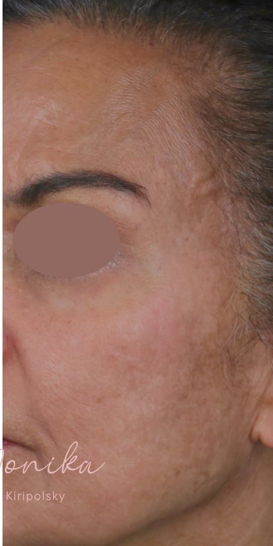 After: Chemical Peel Before & After Patient #1665