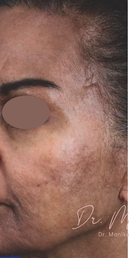 Before: Chemical Peel Before & After Patient #1665