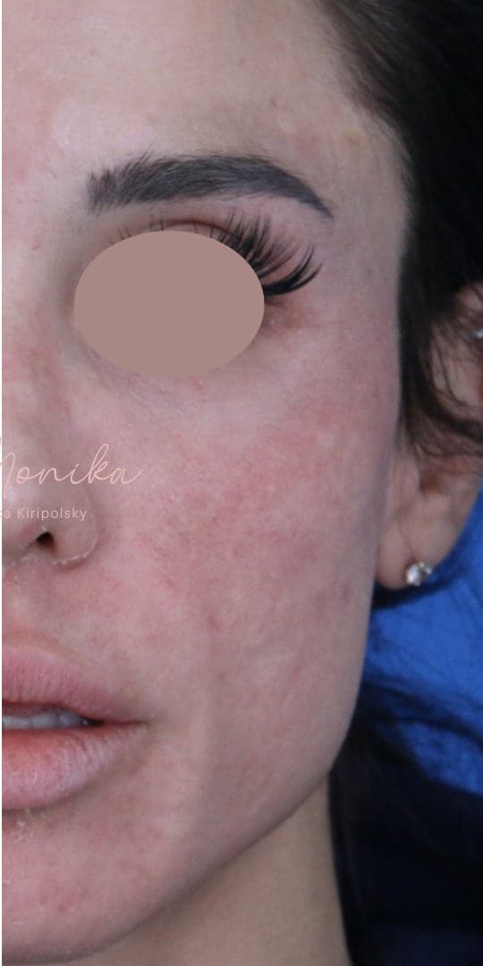 After: Chemical Peel Before & After Patient #1843