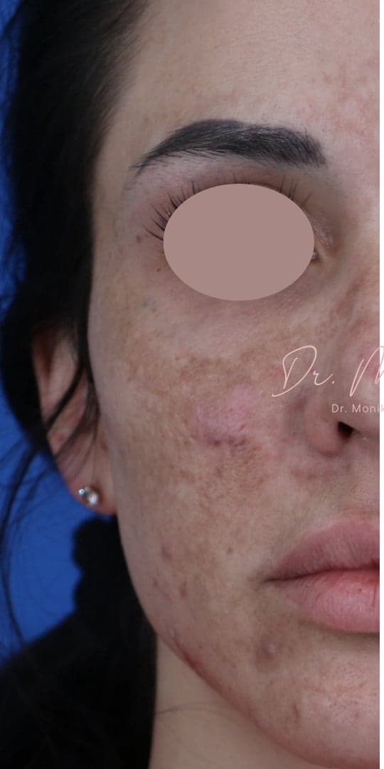Before: Chemical Peel Before & After Patient #1843