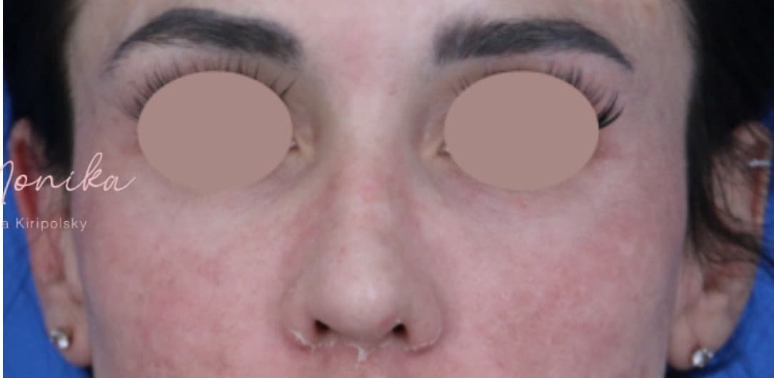After: Chemical Peel Before & After Patient #1843