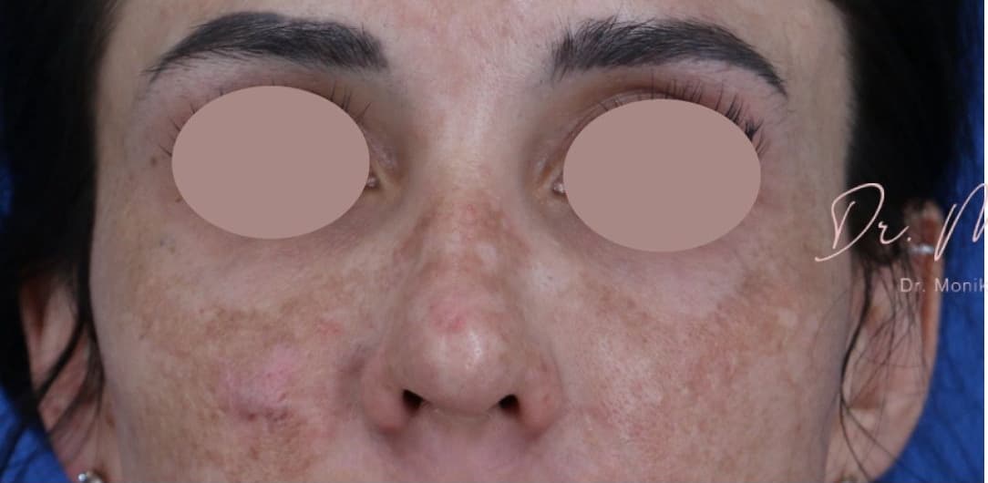 Before: Chemical Peel Before & After Patient #1843