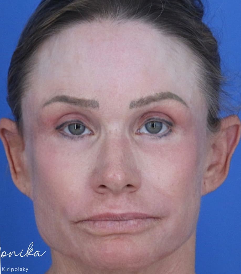 After: Chemical Peel Before & After Patient #2185